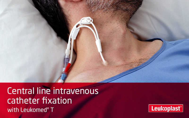 In this video, we see how a central venous catheter injection site is secured using transparent film as an adhesive dressing: We see a healthcare worker apply Leukomed T to a patient's throat and secure a catheter.  In this video, we see how a central venous catheter injection site is secured using transparent film as an adhesive dressing: We see a healthcare worker apply Leukomed T to a patient's throat and secure a catheter.